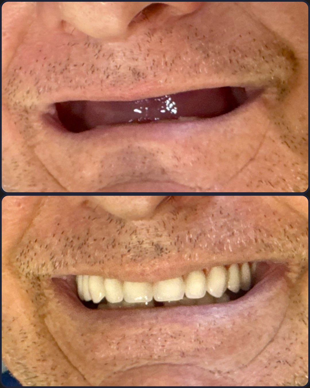 Antes e depois - Facetas de porcelana