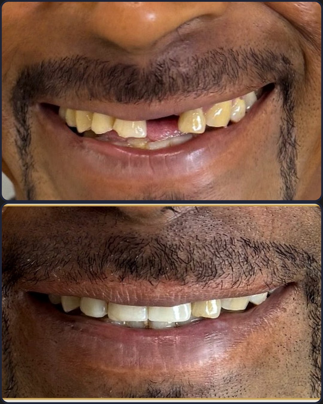 Antes e depois - Implante + Facetas