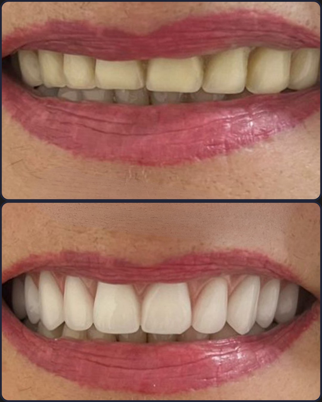Antes e depois - Facetas de porcelana