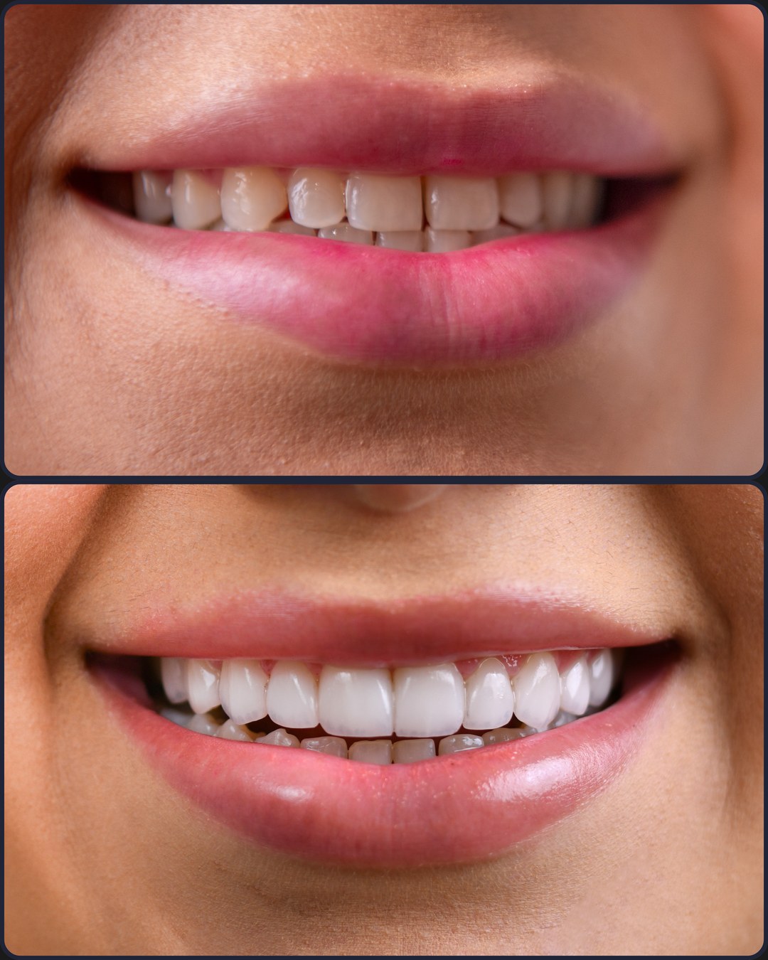 Antes e depois - Implante dentário