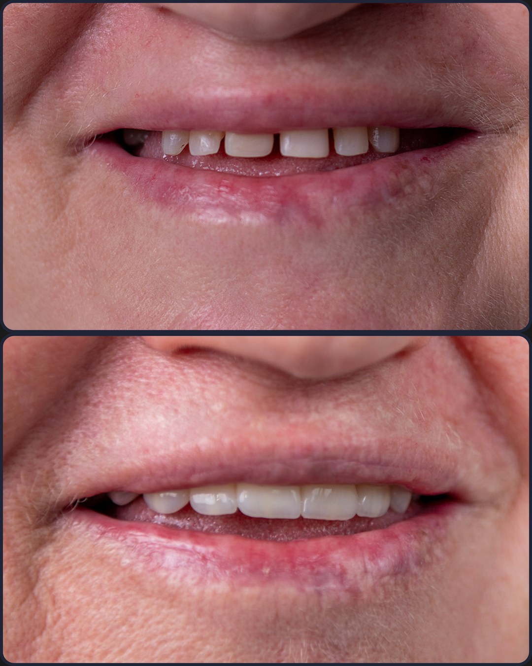 Antes e depois - Facetas de porcelana