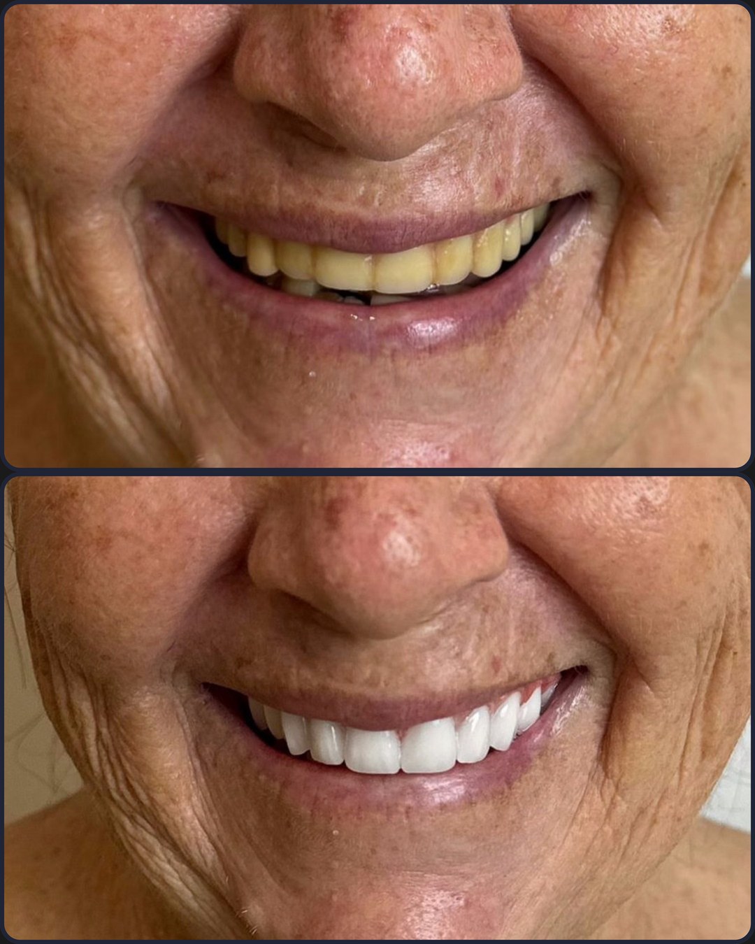 Antes e depois - Implante + Facetas
