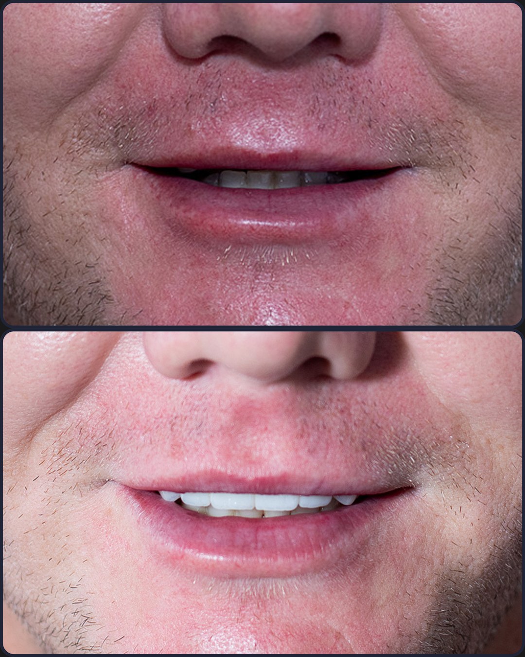 Antes e depois - Prótese sobre implantes + Facetas