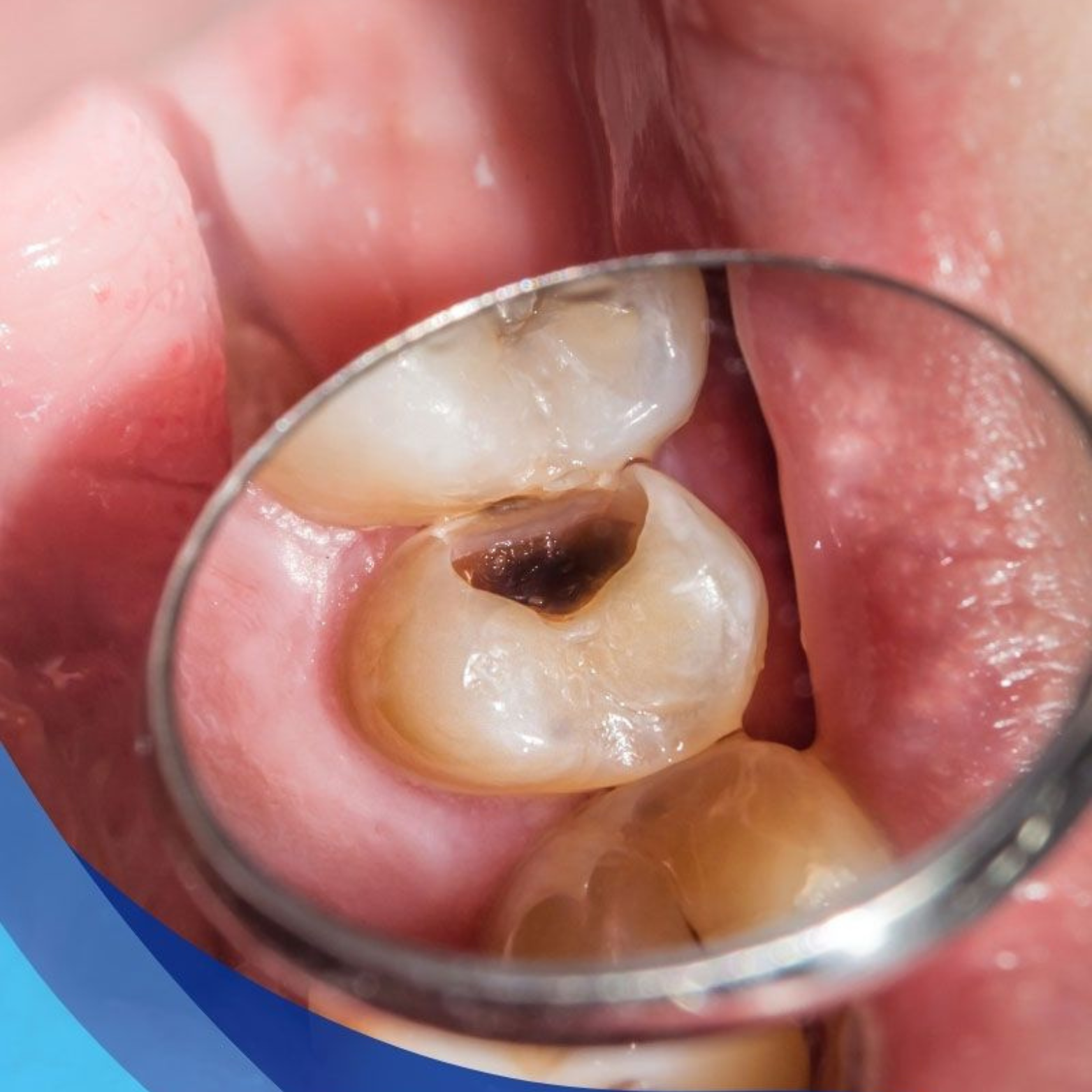 Endodontia (Canal) - OdontoSin