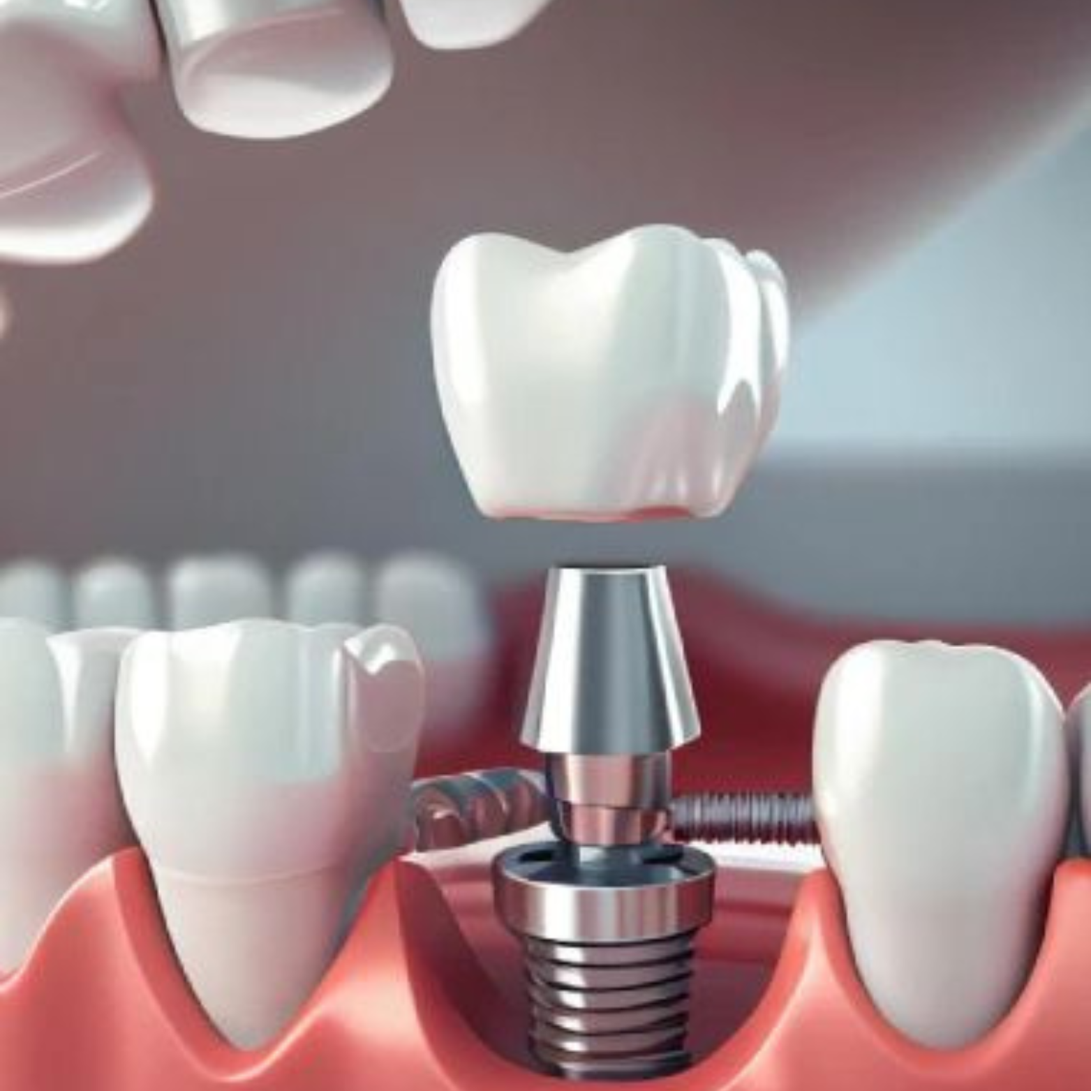 Implante Dentário - OdontoSin