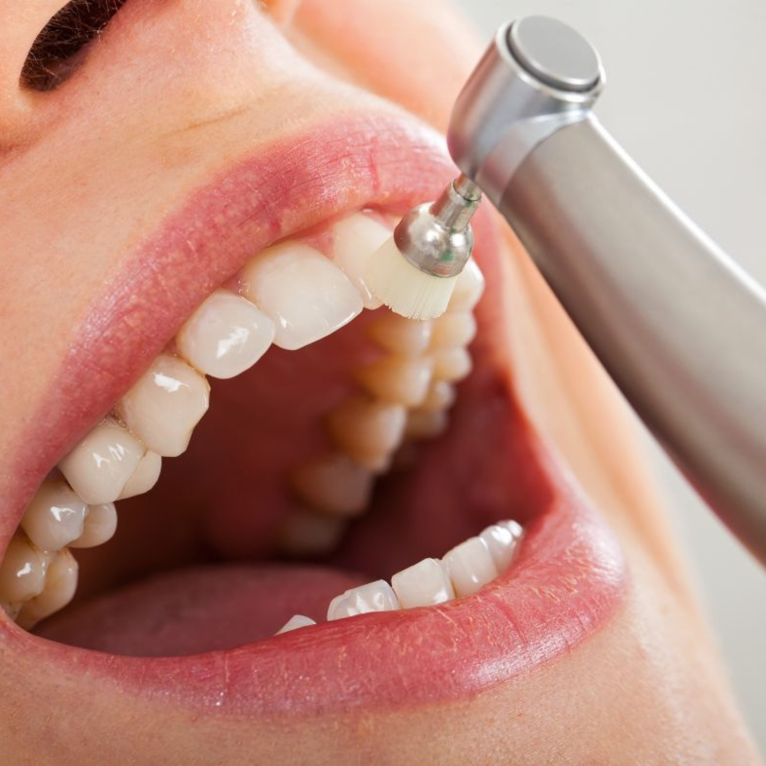 Limpeza Dentária - OdontoSin