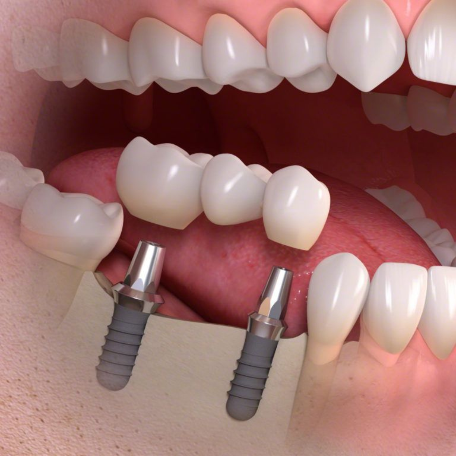 Prótese Protocolo (All-on-4) - OdontoSin